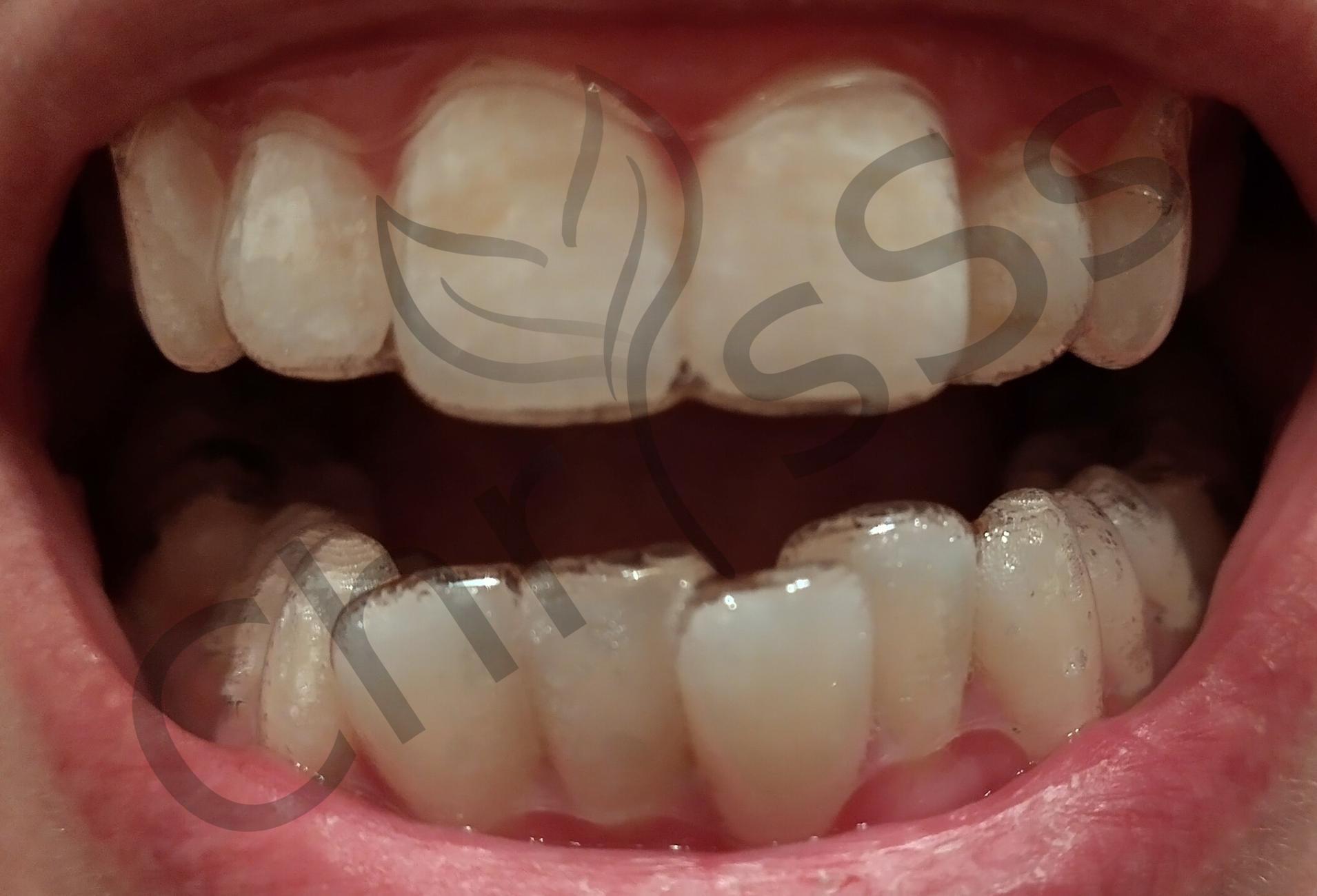 Dent avant appareil 1950x1300
